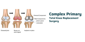 Primary Knee Replacement Surgery in Delhi NCR