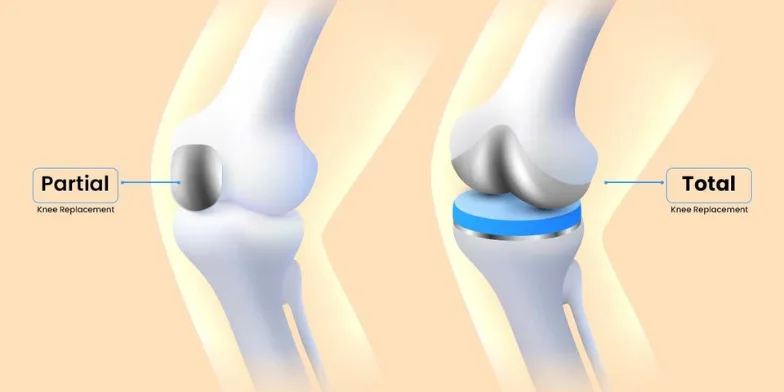 partial knee replacement surgeons in delhi ncr