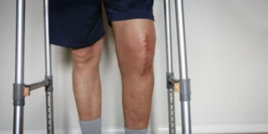 Knee Replacement Surgery Success Rate