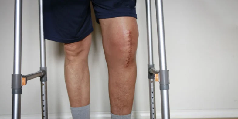 Knee Replacement Surgery Success Rate