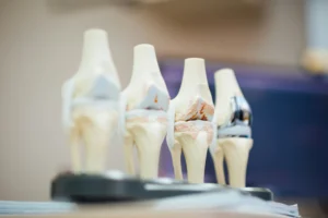 Cemented Hip Replacement