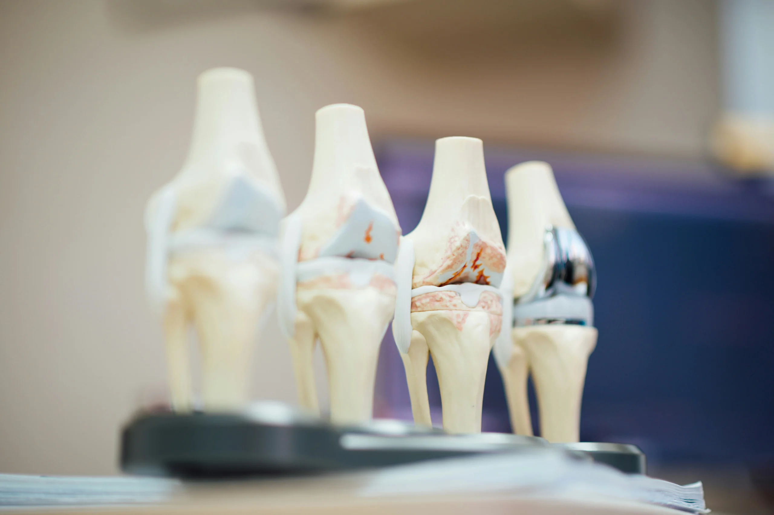 Cemented Hip Replacement