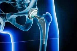 Hip Prosthesis Types